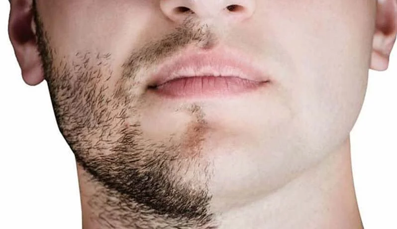کاشت ریش و سبیل